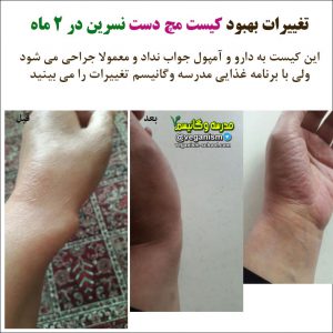 درمان کیست مچ دست با خام گیاهخواری