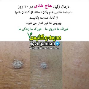 درمان زگیل با خام گیاهخواری