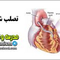 تصلب شرایین