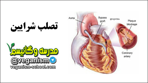تصلب شرایین