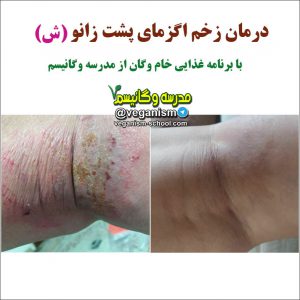 درمان اگزما با خامگیاهخواری