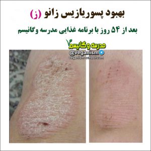 درمان پسوریازیس با خامگیاهخواری